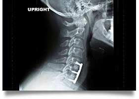 Spinal Cord Injury Lawyers Oklahoma